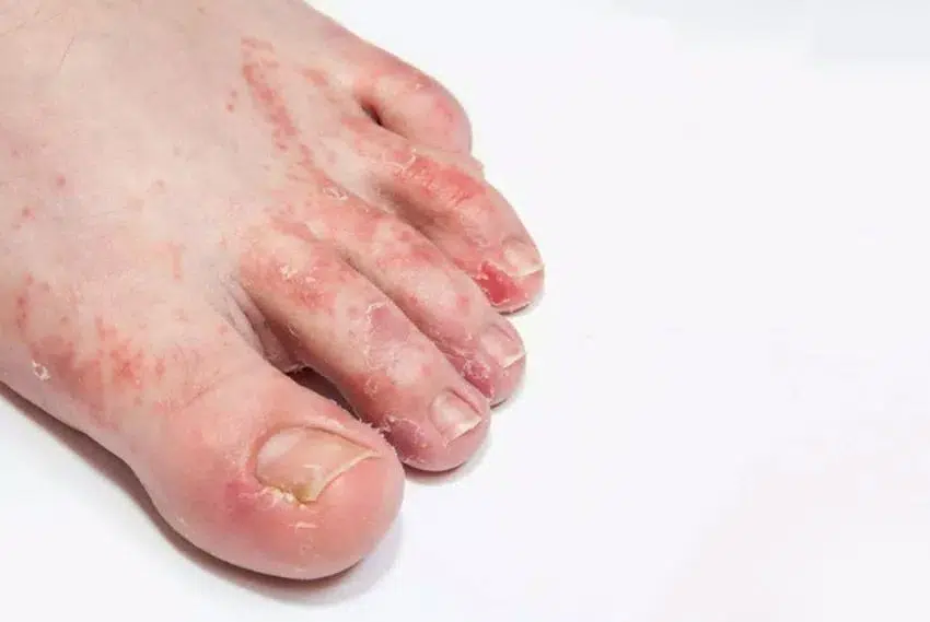 orthaheel thongs athlete's foot